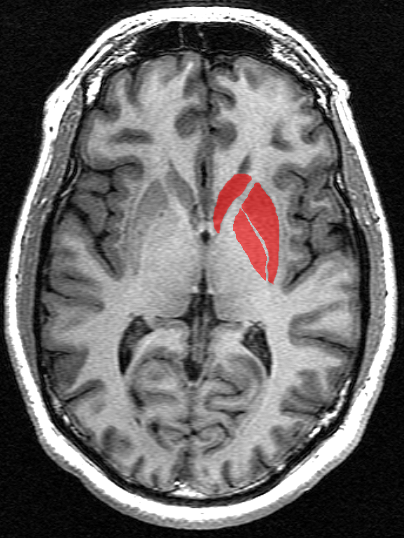 I gangli della base (in rosso) sono un gruppo di aree interconnesse, all'interno della parte centrale del cervello. Queste regioni del cervello sono da sempre riconosciute come le principali responsabili del danno che si presenta nel corso della malattia.