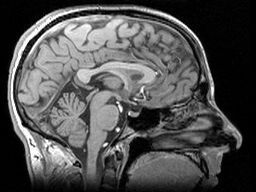 Il maggior volume raggiunto dal cervello potrebbero essere più piccolo negli uomini con la mutazione HD  