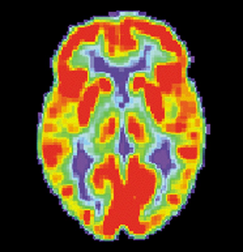 FDG-PET scan ci permettono di vedere quanto zucchero sta usando ogni parte del cervello. Questo é uno scan della salute del cervello. Le aree rosse stan consumando la maggior quantità di zucchero.  