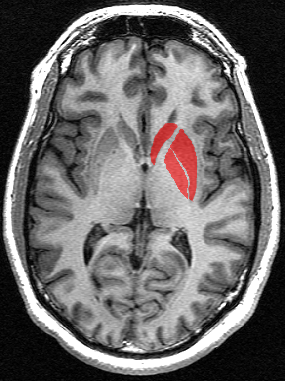 I gangli della base (in rosso) sono un gruppo di aree interconnesse, all'interno della parte centrale del cervello. Queste regioni del cervello sono da sempre riconosciute come le principali responsabili del danno che si presenta nel corso della malattia.  