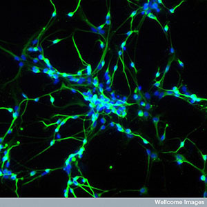 LLa combinazione di terapia genica e cellule staminali offre la prospettiva di trattare i  pazienti con le loro stesse cellule 'riparate'- ma molte sfide rimangono prima che possa essere utilizzata per la MH.   